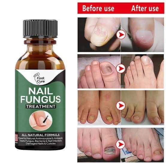 Nail Fungus Treatment Stop Fungal Growth