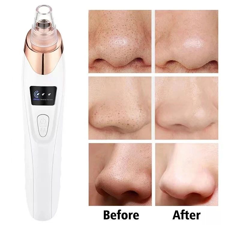 Upgraded Blackhead Remover Vacuum Facial